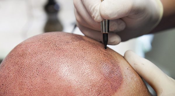 Scalp Micropigmentation Cost Procedure Dhi San Diego