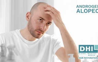 Androgenic alopecia