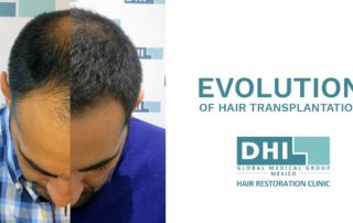 Hair Transplant