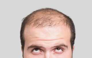 Cheap Hair Transplant