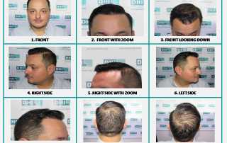 How many grafts are needed to cover the area that has been affected by alopecia