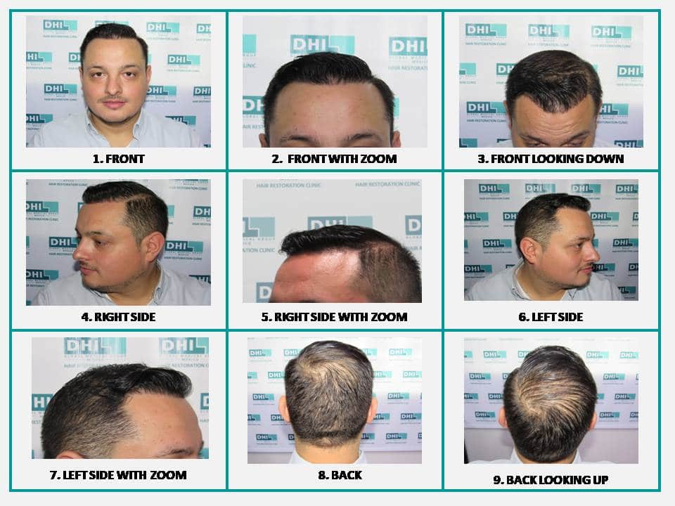Hair transplant timeline: discover the evolution month by month