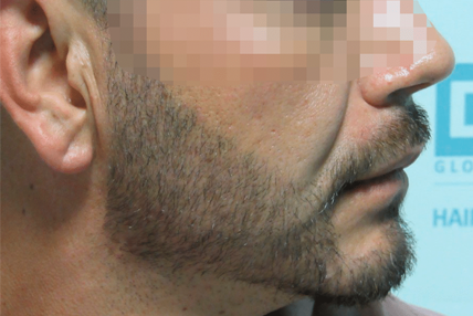 beard-transplant-after-6
