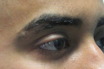 eyebrow-transplant-before-4