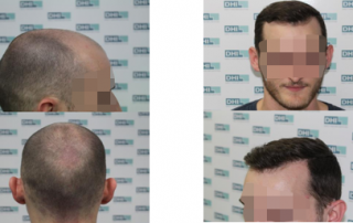 alopecia androgénica