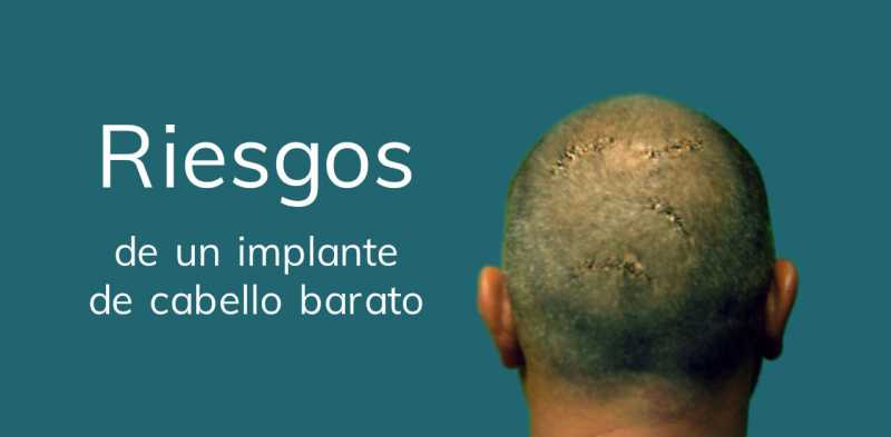 Imagen de paciente con cabello dañado por implante de baja calidad