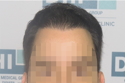 Despues de Injerto de Cabello